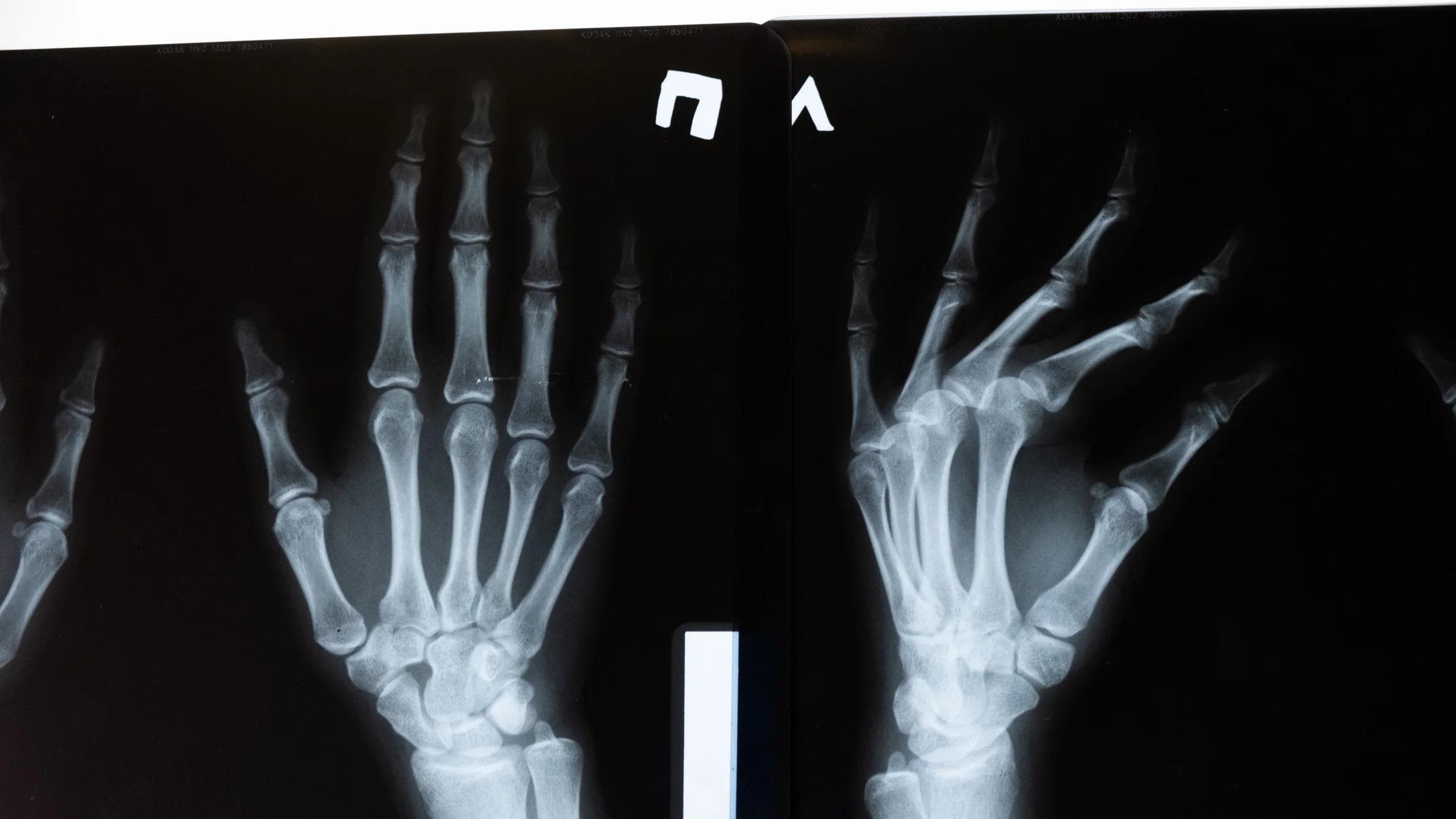 High-resolution x-ray image showing the intricate anatomy of human hands.